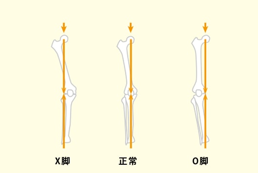 大腿骨の傾き